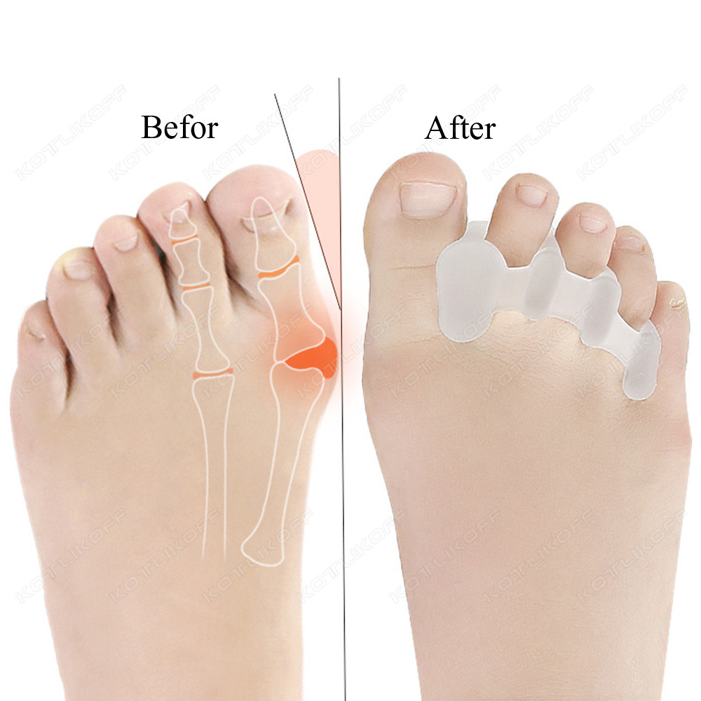 つま先保護 つま先セパレーター シリコーン外反母趾 外反母趾 - Toe Separator Silicon のレビューと価格